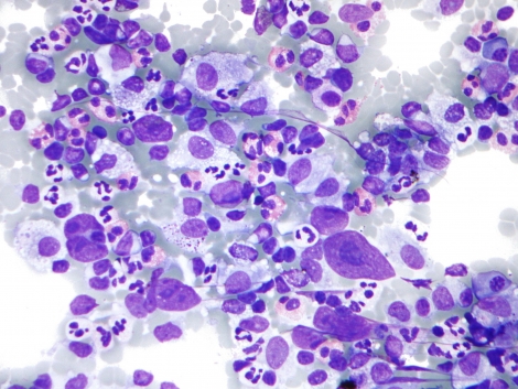 Hodgkin_lymphoma_cytology_large