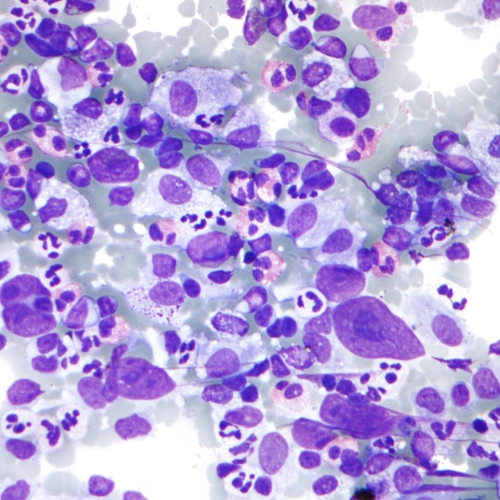 Hodgkin_lymphoma_cytology_large
